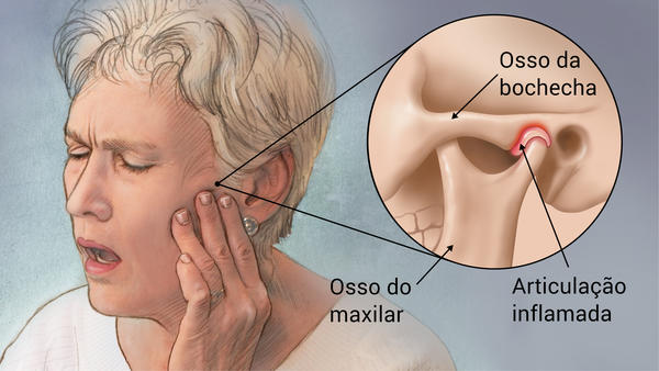 Enxaqueca com aura por ATM disfunção temporomandibular